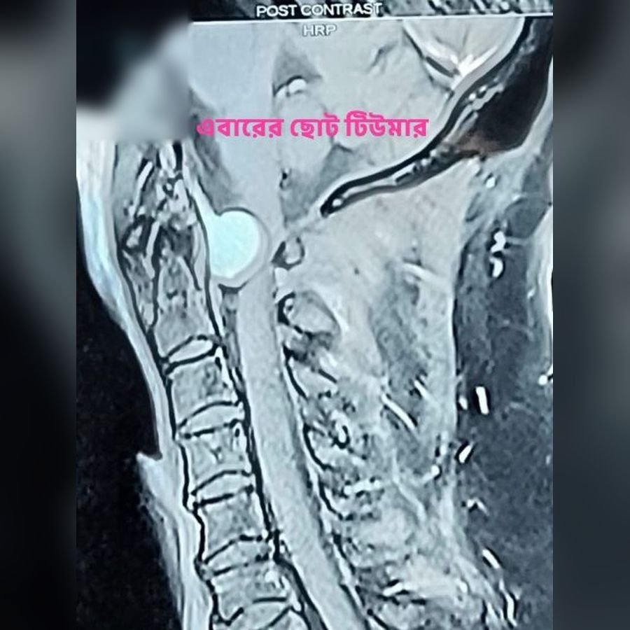 After surgery: Cervical spine tumour