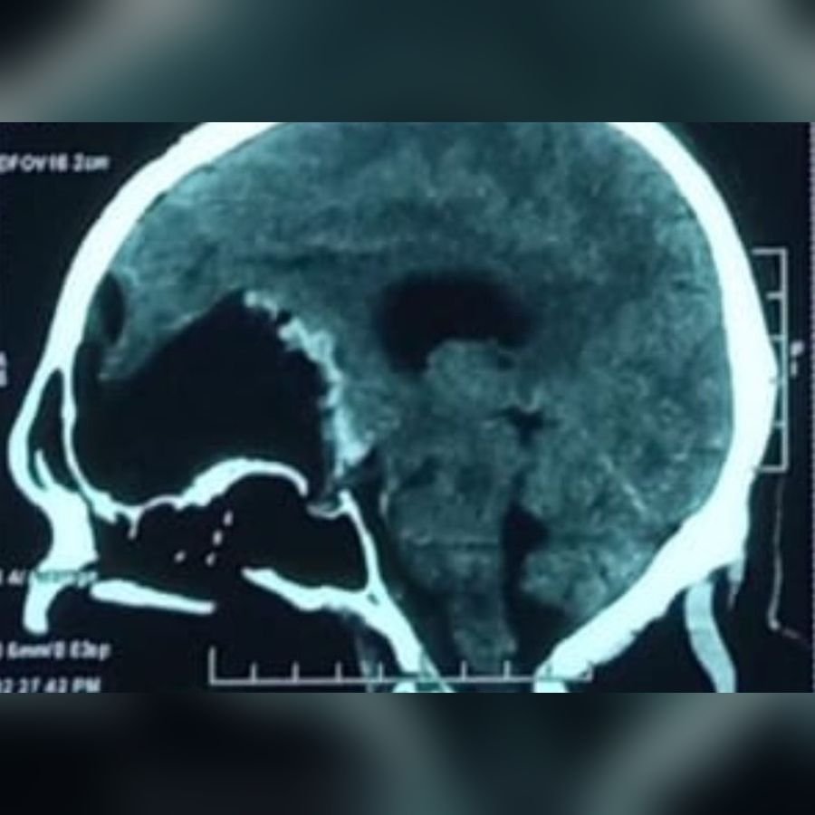 After surgery: Large brain tumour