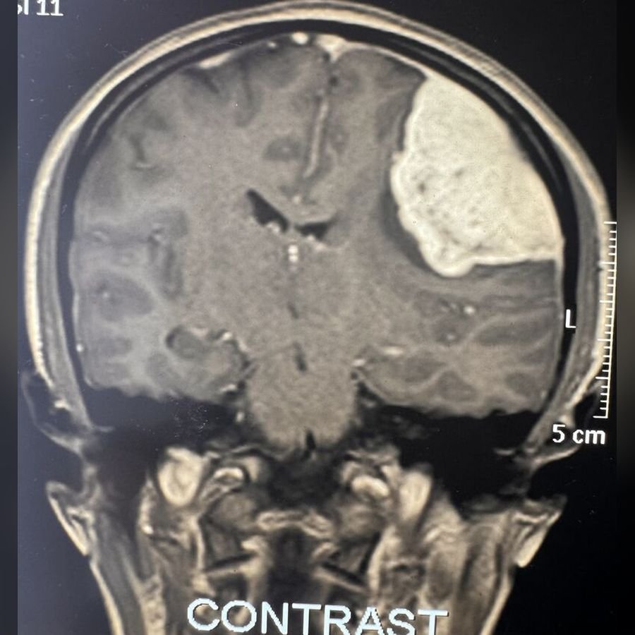 Before surgery: Meningioma
