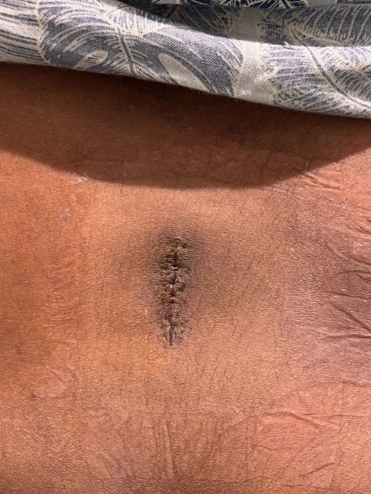 PLID incision photo 1