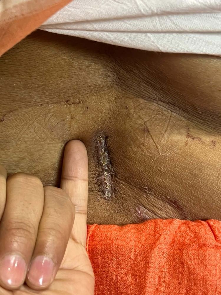 PLID incision photo 2
