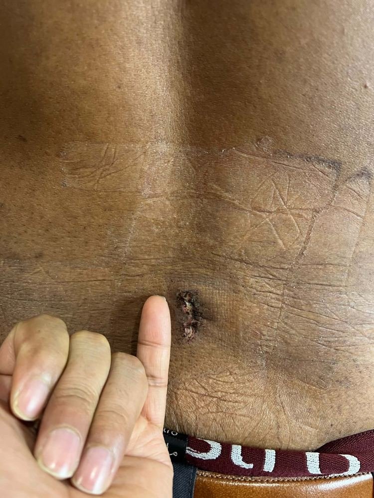 PLID incision photo 4