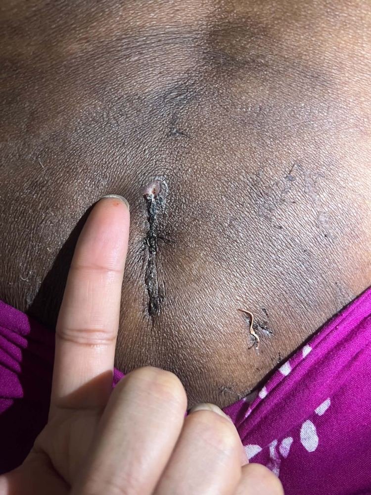 PLID incision photo 5
