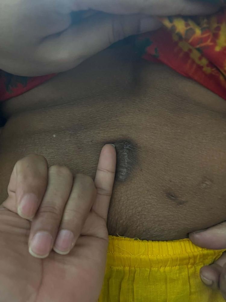 PLID incision photo 6