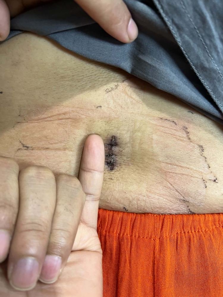 PLID incision photo 7