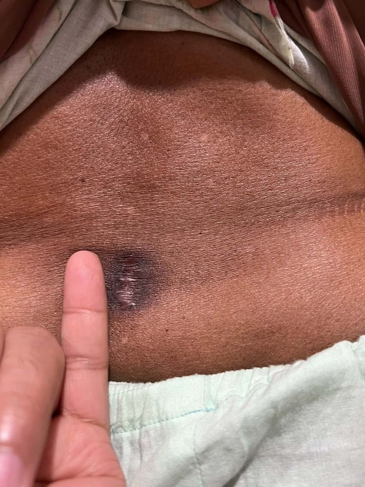 PLID incision photo 8