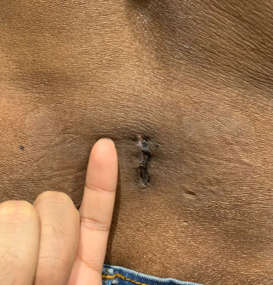 PLID incision photo 10